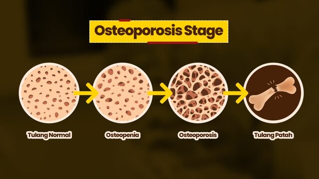 Penyebab Utama Osteoporosis Dini